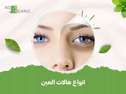 انواع هالات العين